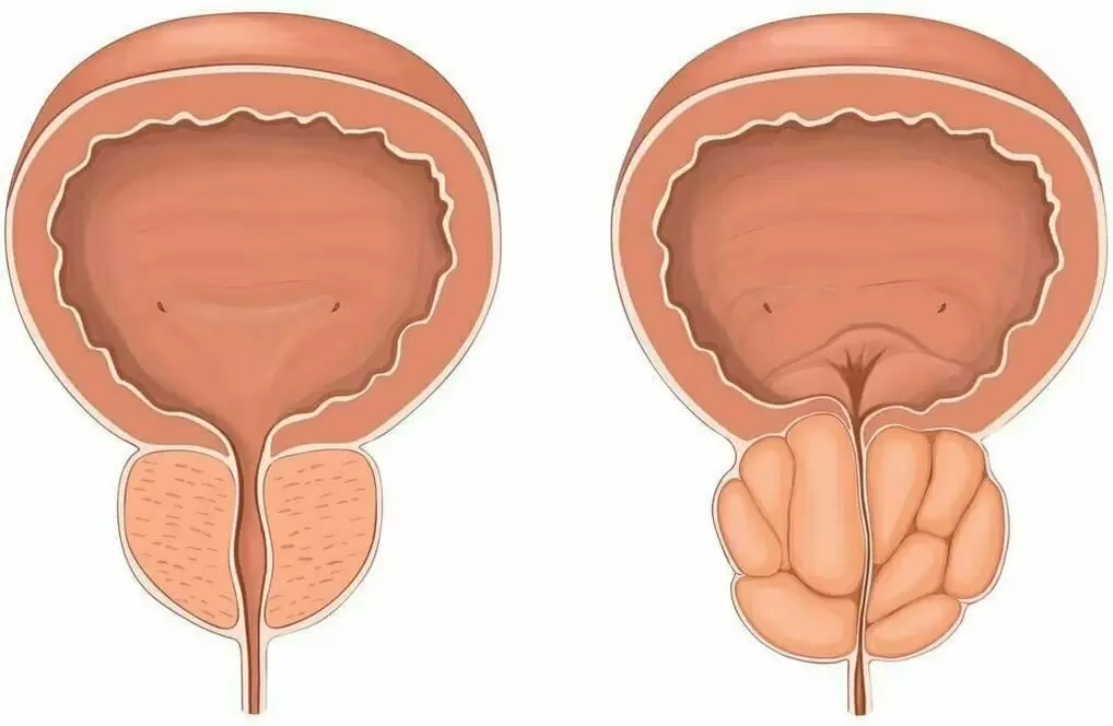 normal and diseased prostate