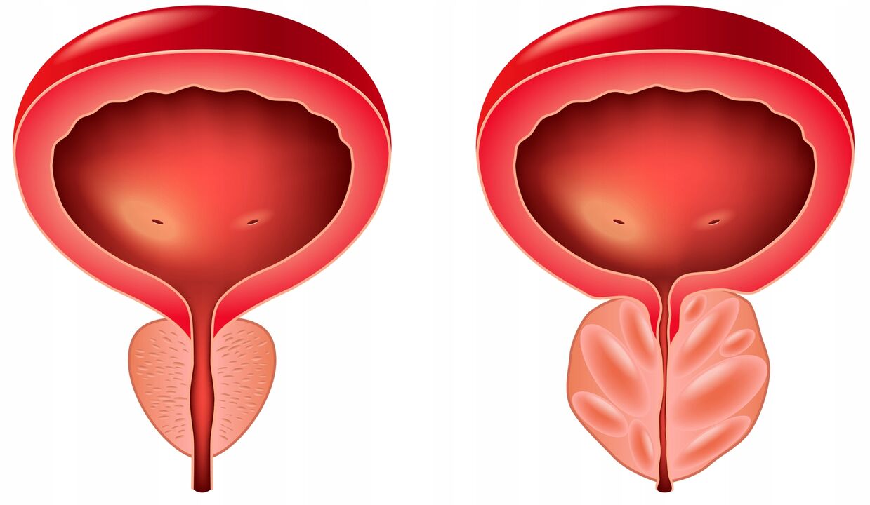 the difference between the prostate